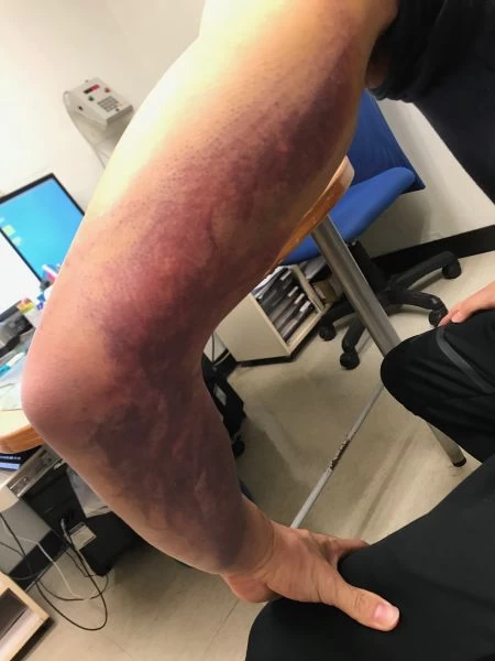 李智凱左肩疼痛腫脹僵硬,瘀傷往下沉至手肘。
