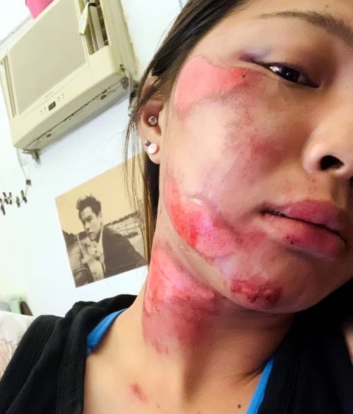 邱靜雯的右臉摔得很嚴重。邱靜雯/提供。