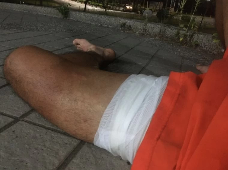周俊宏第三天燒襠嚴重。周俊宏提供