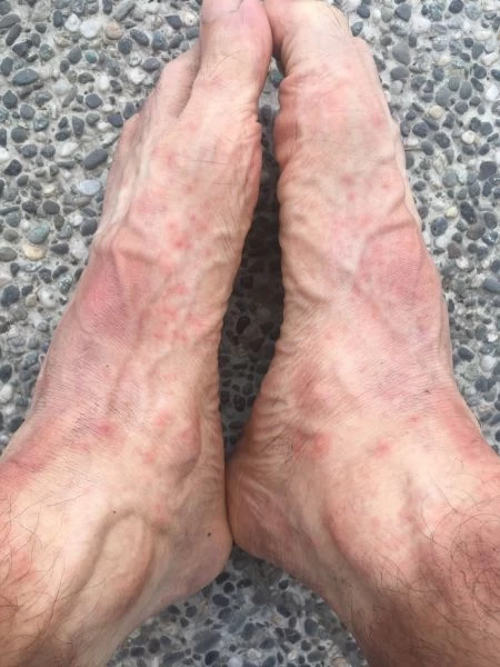 周俊宏跑到腳上發紅起溼疹。周俊宏提供