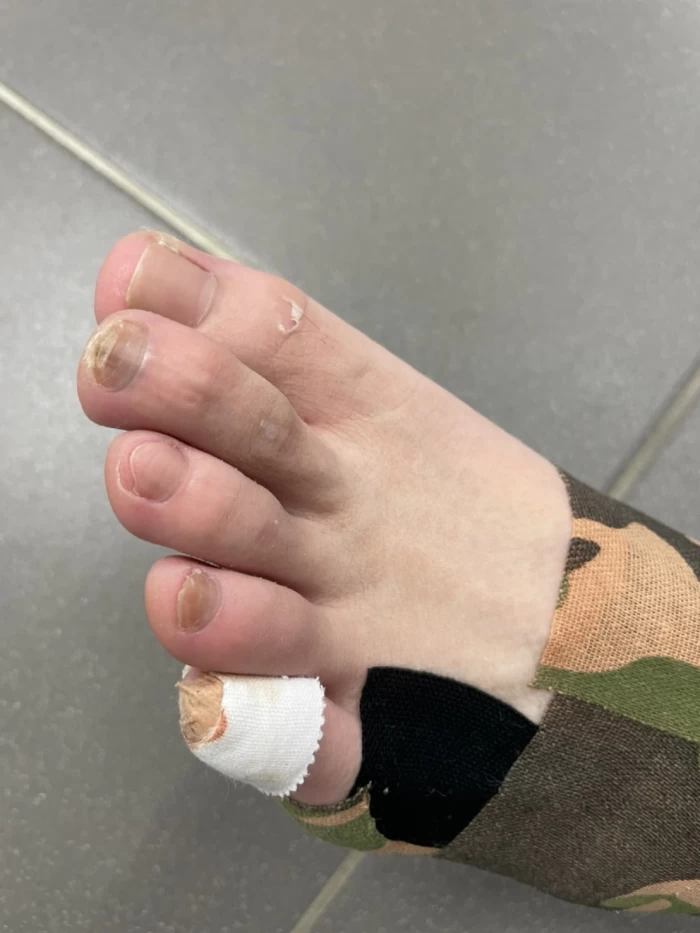 雙打決賽前夕,李羽芸因不慎踢到桌腳,造成左腳小拇指指甲外翻,決賽中只能強忍痛處迎戰。蔡怡甄提供