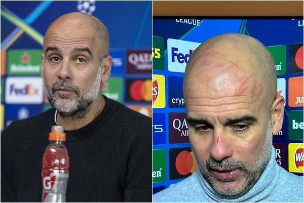曼城總教練瓜迪奧拉(Pep Guardiola，右)賽後記者上的臉部傷痕清晰可見。合成照片