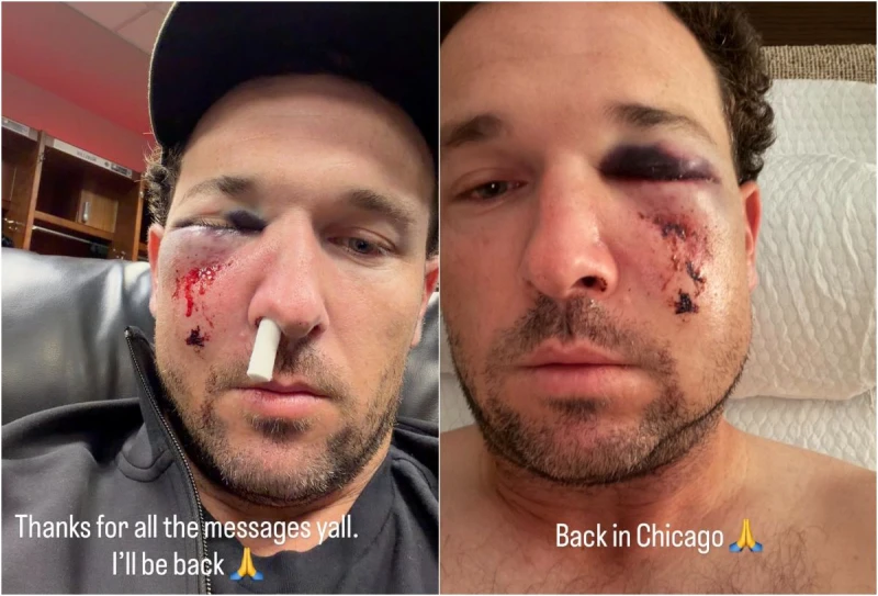 芝加哥小熊球星柏格曼(Alex Bregman)日前遭擦棒球打中,臉部出現骨折。合成照片
